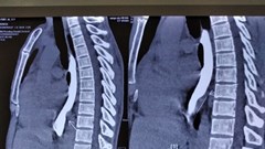 Gắp xương cá nằm trong khối u xơ cho một thanh niên