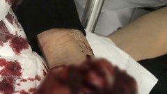 Dập nát bàn tay vì nghịch pháo tự chế