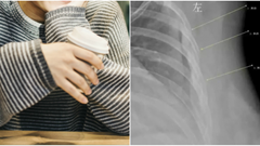 Uống 10 cốc cà phê mỗi ngày trong 7 năm, cô gái 30 tuổi có xương như cụ già