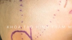 Để trẻ đến trường không bị mặc cảm vì vành tai dị tật