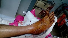 Quảng Nam: Nối thành công bàn chân gần đứt lìa do máy cắt cỏ