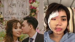 Vụ cựu thiếu úy  công an tạt axit vợ chưa cưới: Quá tàn độc và coi thường pháp luật