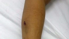 Bé 5 tuổi bị đạn súng hơi găm vào tay