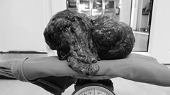 Loại bỏ khối u mạc treo ruột hiếm gặp