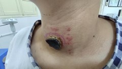 Tin “thầy lang” chữa bệnh, cô gái bị nhiễm trùng, loét vùng cổ nghiêm trọng