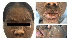 Mặt nổi vẩy sần sùi như “da voi” chỉ vì dùng mỹ phẩm làm trắng da