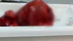 “Bóc” khối u xơ nặng 4,5kg trong tử cung người phụ nữ 60 tuổi