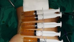 Bơm ngực, một phụ nữ có một bên ngực to gấp 3 – 4 lần bên kia