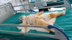 Ba cháu bị bỏng ở nhóm trẻ mầm non tư thục Tuổi Thơ có chuyển biến tốt