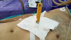 Cứu sống bệnh nhân bị hai nhát dao đâm thấu bụng