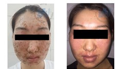 Gánh “tai hoạ” vì mua bột rửa mặt làm đẹp trên mạng
