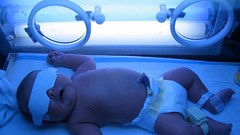 Chủ quan với bệnh vàng da có thể dẫn đến bại não ở trẻ sơ sinh