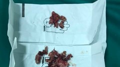 Cháu bé 15 tuổi đã bị u tuyến giáp