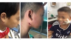 Nghệ An: 3 bệnh nhi mắc bệnh nhiễm "vi khuẩn ăn thịt người", 1 cháu đã được xuất viện