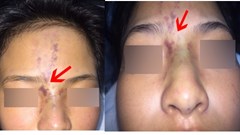 Bé 13 tuổi mất thị lực do tiêm filler thẩm mỹ