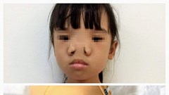 Bác sĩ y khoa từ Mỹ đến Huế phẫu thuật thành công dị tật hiếm gặp cho bệnh nhi