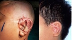 Việt Nam thực hiện thường quy kỹ thuật phẫu thuật tạo hình dị tật tai nhỏ tiên tiến nhất thế giới