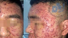 Dùng thuốc nam không nguồn gốc, nam thanh niên mụn bọc đầy mặt