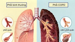 Mỗi năm có 25 nghìn ca tử vong do bệnh tắc nghẽn phổi mãn tính