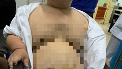 Lần đầu ở Việt Nam phẫu thuật bắc cầu động mạch vành cho người bệnh lùn bẩm sinh và béo phì