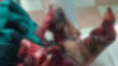 Tự học làm pháo, cậu bé lớp 9 phải cắt cụt bàn tay vì thuốc nổ