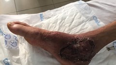 Suýt mất chân do tự điều trị thuốc nam tại nhà