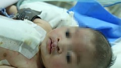 Bé gần 2 tháng tuổi đã trải qua 2 cuộc phẫu thuật tim và hở môi