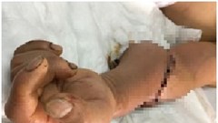 Nối liền cánh tay cho bệnh nhân bị máy nghiền bột cắt lìa