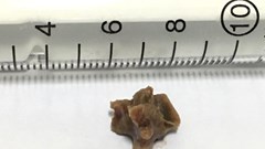 Lấy dị vật ở phế quản đã “bỏ quên” suốt 5 năm