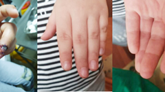 Phẫu thuật kịp thời cứu búp ngón tay cho bé trai người Nga