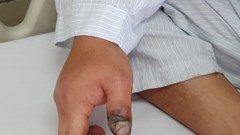 Liên tiếp bệnh nhân bị rắn cắn