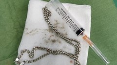 Gắp sợi dây chuyền do bé 29 tháng tuổi nuốt vào dạ dày