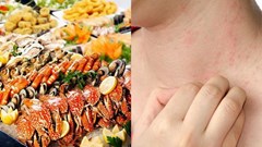 Cẩn trọng với dị ứng thực phẩm mùa du lịch