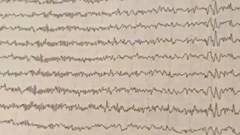 Yêu cầu Bệnh viện Bạch Mai làm rõ thông tin về thời gian đo điện não video