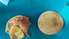 “Cứu” vòng 1 của một phụ nữ bị vỡ túi nâng ngực