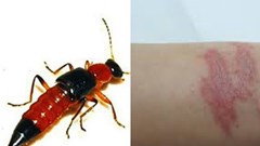 Hà Nội: Hàng nghìn trường hợp nhiễm độc kiến ba khoang phải vào viện