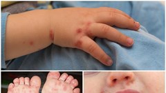 Không nên hoang mang việc thiếu thuốc điều trị bệnh tay chân miệng ở trẻ em