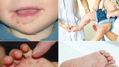 Thông tin không có thuốc điều trị bệnh tay chân miệng là thiếu chính xác