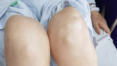 Báo động gia tăng tình trạng lạm dụng corticoid