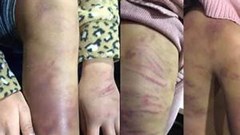 Hà Nội: Khẩn trương làm rõ bé gái 12 tuổi bị mẹ bạo hành