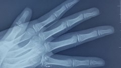 Trẻ bị nhiễm độc thuỷ ngân vì vỡ nhiệt kế