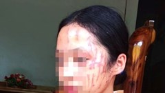 Nữ sinh bị cào rách mặt vì bênh em gái