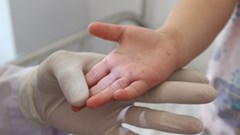 Hà Nội: 28 quận, huyện, thị xã có ca mắc tay chân miệng