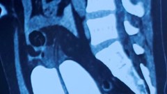 Nguy cơ vỡ bàng quang sau khi uống bia