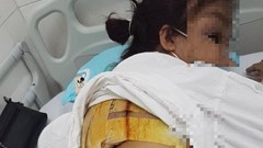 Nguy cơ biến chứng áp xe do chỉ định thuốc bừa bãi