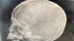 Cục trẻ em đề nghị Công an TP Hà Nội nhanh chóng điều tra vụ việc bé 3 tuổi nghi bị cắm đinh vào đầu