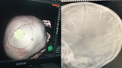 Vụ bé gái bị đinh ghim vào đầu: Cần khẩn trương điều tra làm rõ để xử lý nghiêm minh