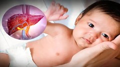 Cảnh giác với bệnh viêm gan “bí ẩn” ở trẻ em