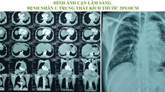 Kon Tum: Phẫu thuật bóc tách thành công khối u trung thất nặng 2kg