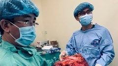 Phẫu thuật thành công cho bệnh nhân nặng 39kg mang khối u 6,5 kg
